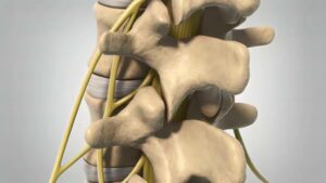The pressure on the nerve roots caused by the spinal cord and degeneration may be caused by the following. Slipped or herniated discs.