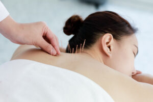 The hand of a doctor performing acupuncture therapy on a woman.